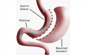 laparoscopic-Sleeve-Gastrectomy