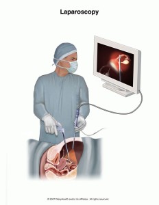 laparoscopy ot