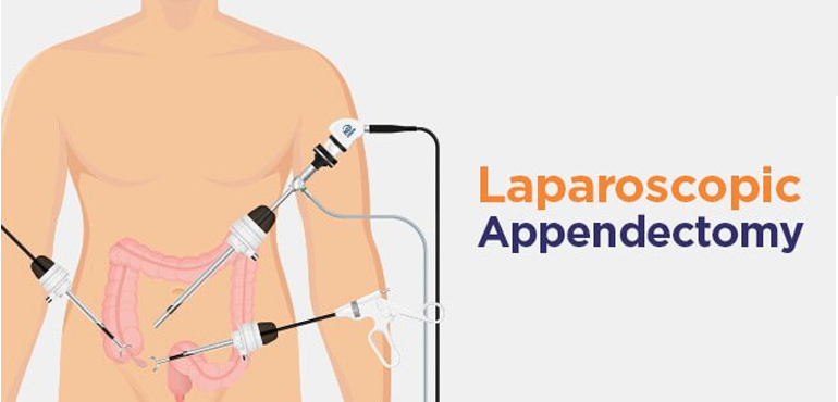 Laparoscopic Appendectomy