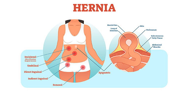 Laparoscopic Epigastric Hernia Repair