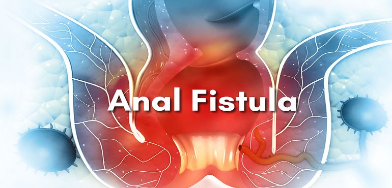 Anal Fistula Treatment in Delhi