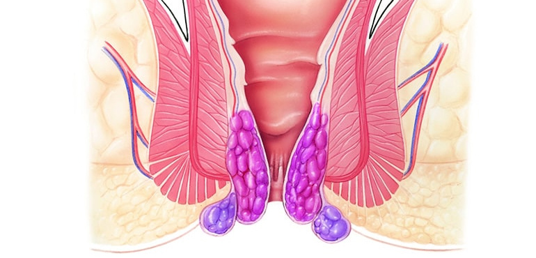 Laser Haemorrhoidectomy