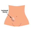 hernia surgery