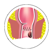 piles treatment