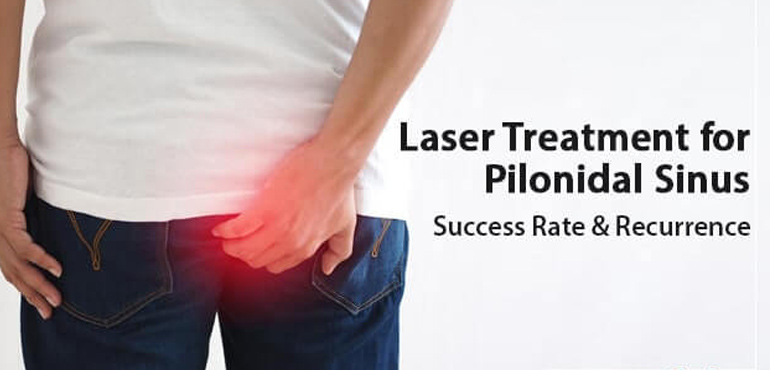 Laser for Pilonidal sinus