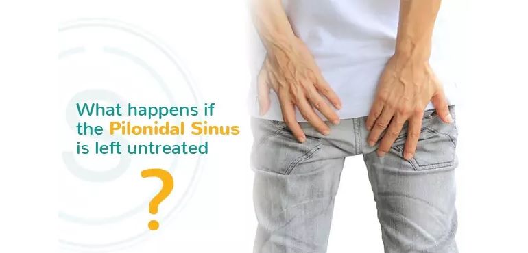 Pilonidal Sinus Doctor in Delhi